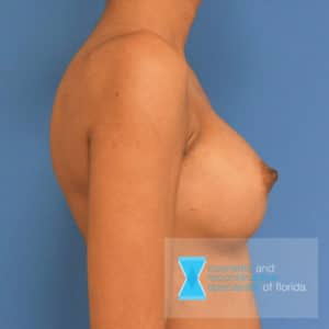 breast augmentation after side