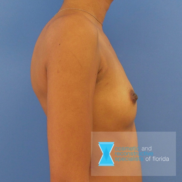 breast augmentation before side