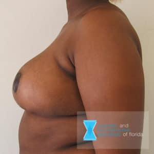 breast red post op side view