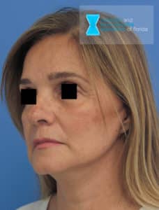 fl post op 45 side view