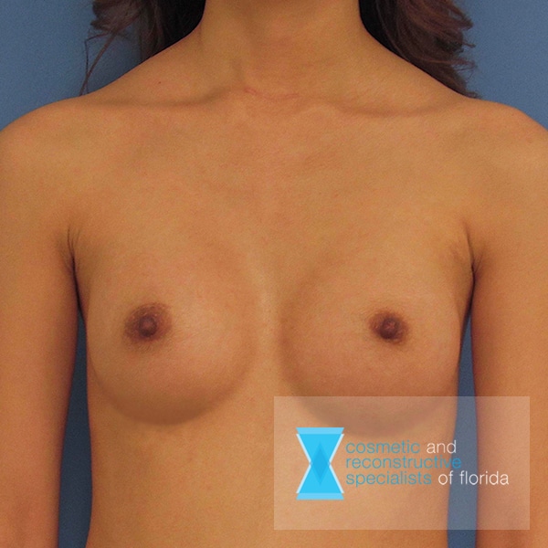 Breast Augmentation - After CRS Plastic Surgery