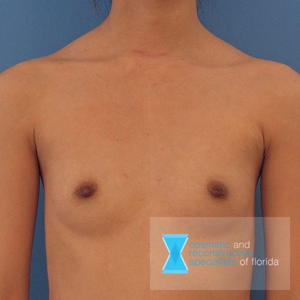 Breast Augmentation - Before CRS Plastic Surgery