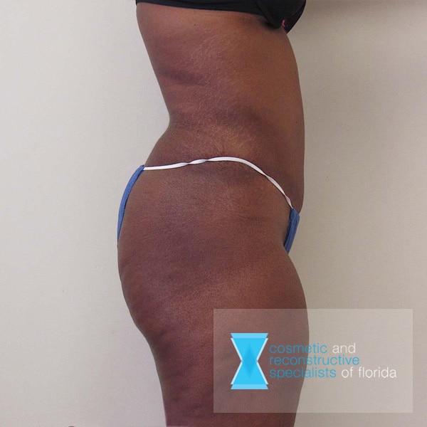 Excess Skin Removal Tummy Tuck After Side