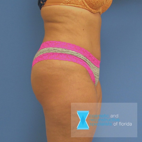 Abdominoplasty Tummy Tuck After Side