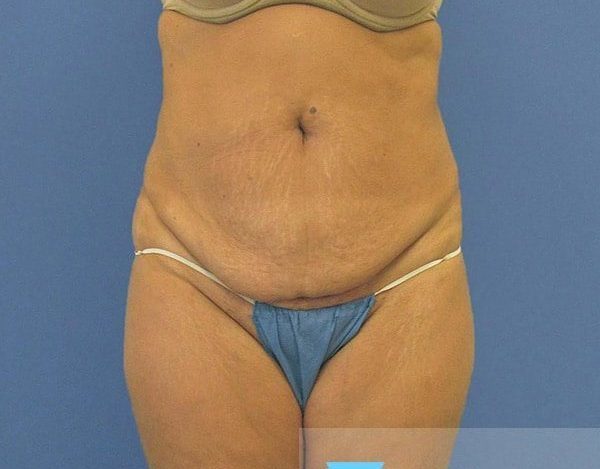 Abdominoplasty Tummy Tuck Before