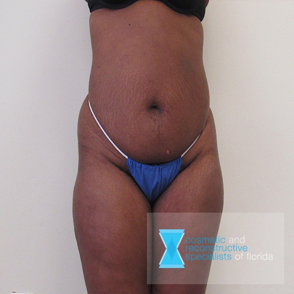 Excess Skin Removal Tummy Tuck Before