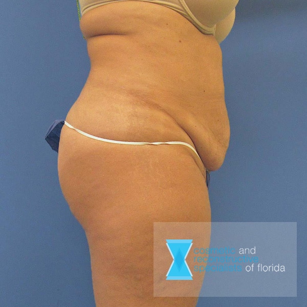 Abdominoplasty Tummy Tuck Before Side