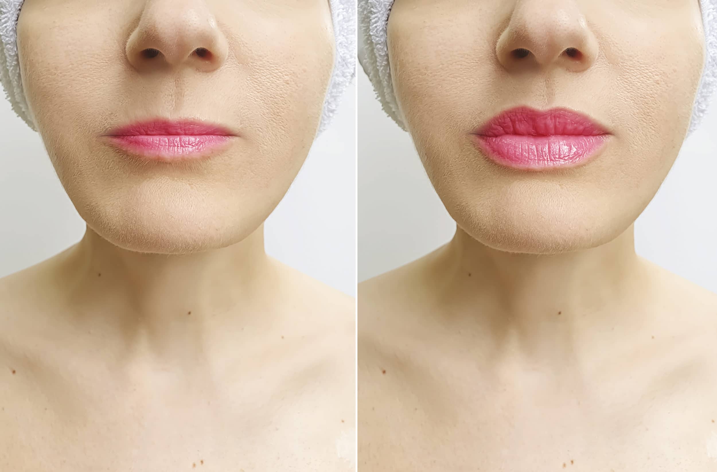 woman lips before and after lip injections