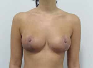 Breast Lift