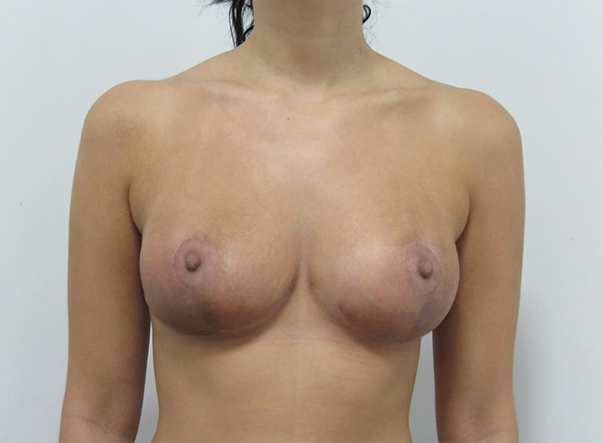 After Image: Breast Lift - front