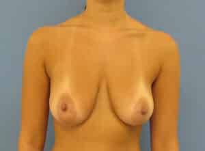 Breast Lift