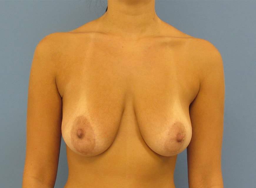Before Image: Breast Lift - front