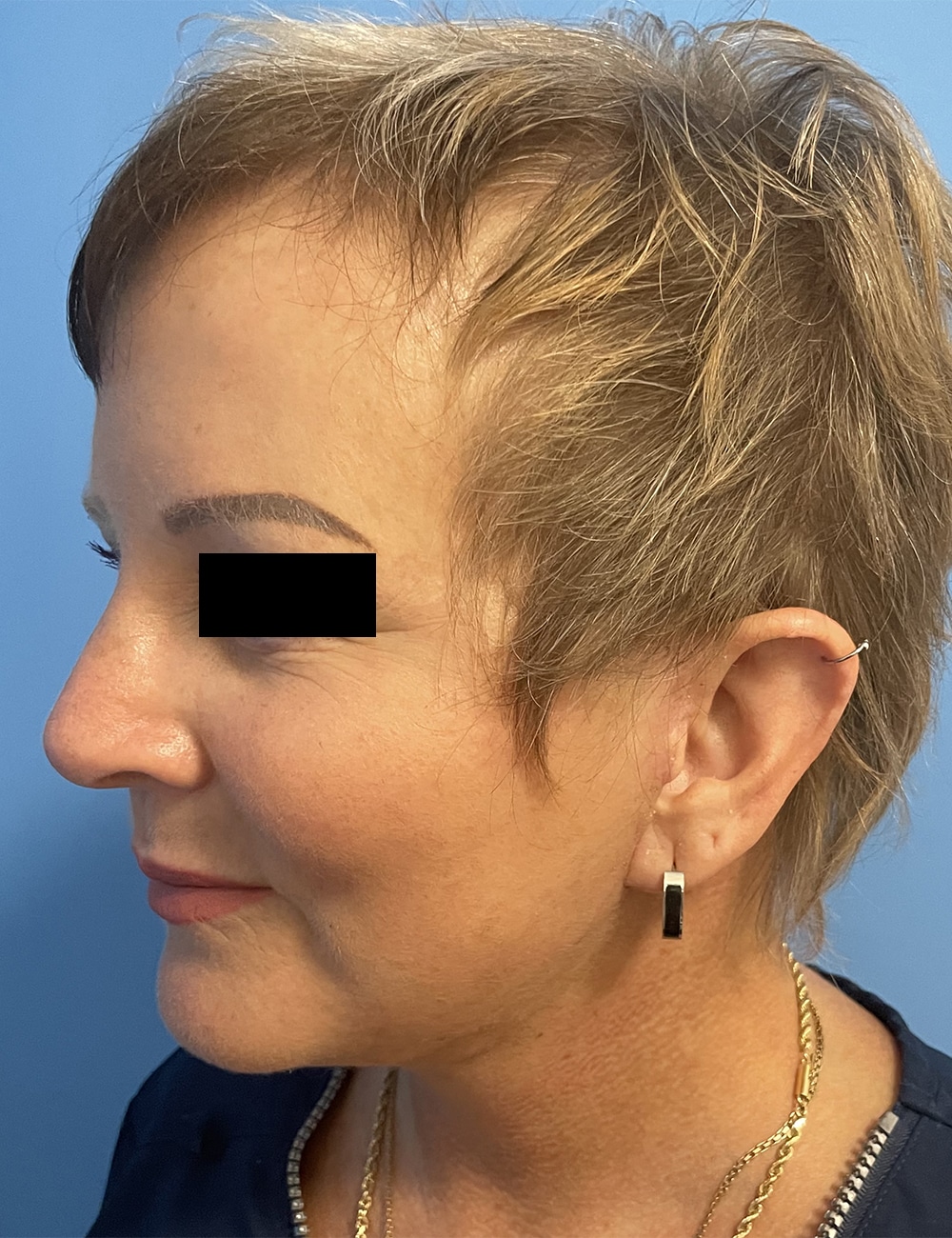After Image: Lower Facelift - left-front-oblique