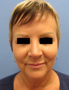 Lower Facelift