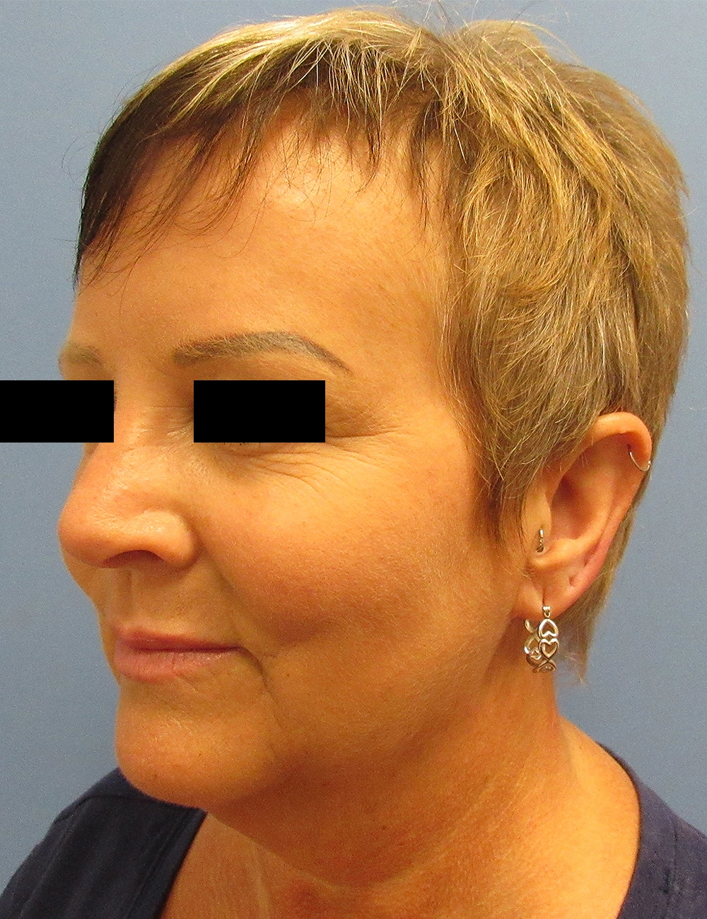Before Image: Lower Facelift - left-front-oblique