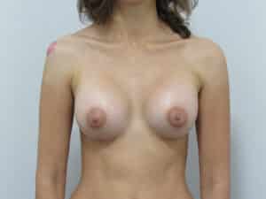 Breast Augmentation