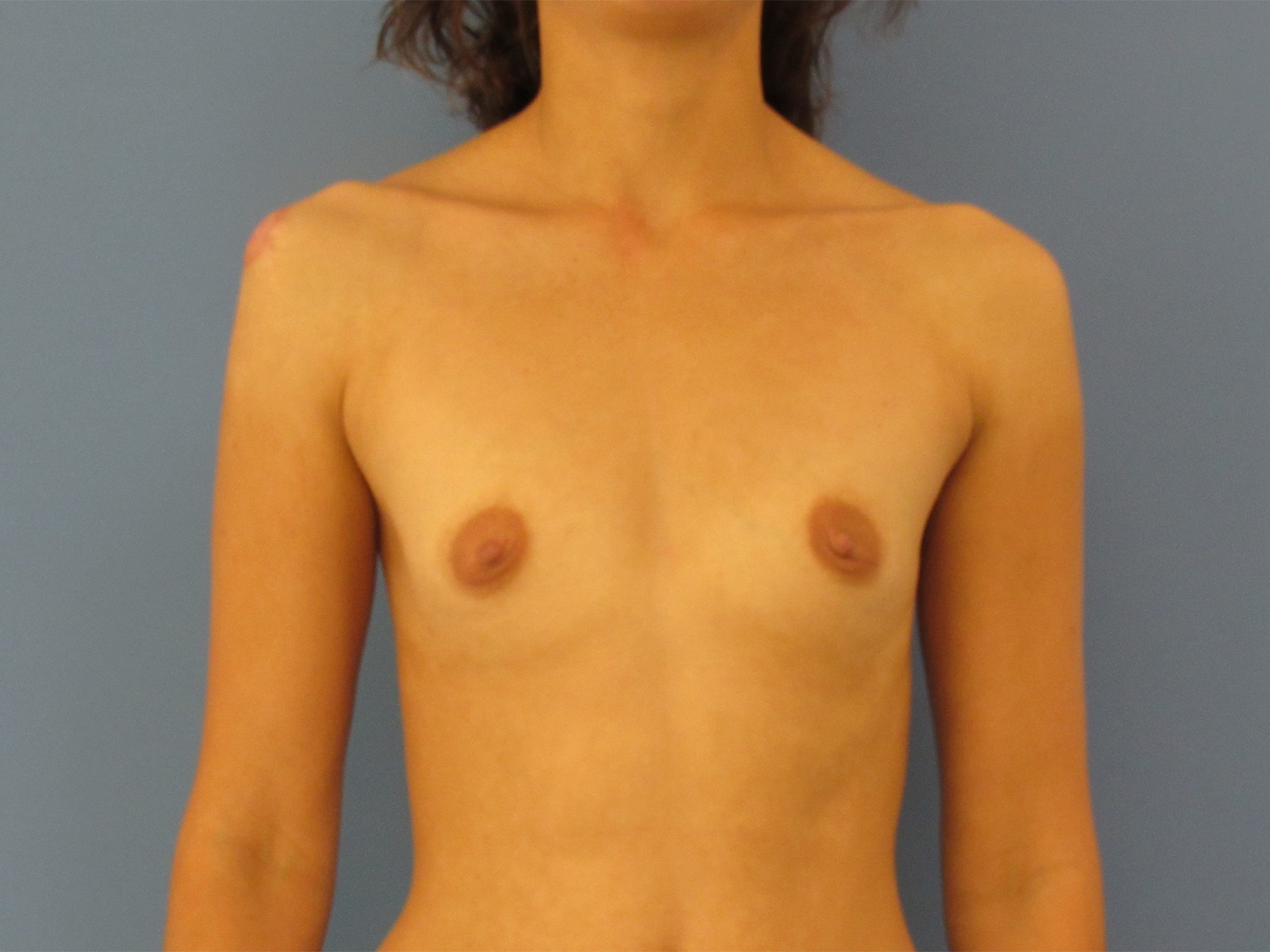 Before Image: Breast Augmentation - front