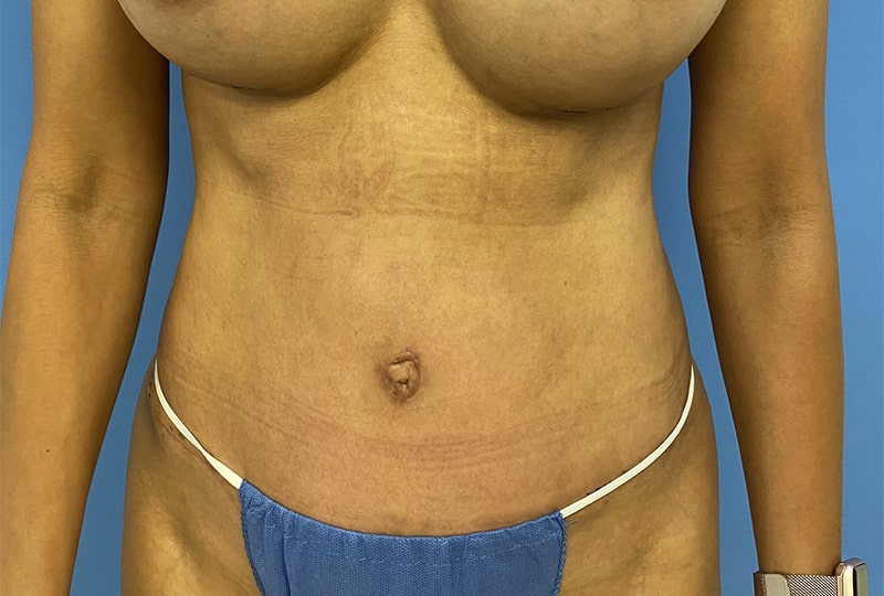After Image: Tummy Tuck - front