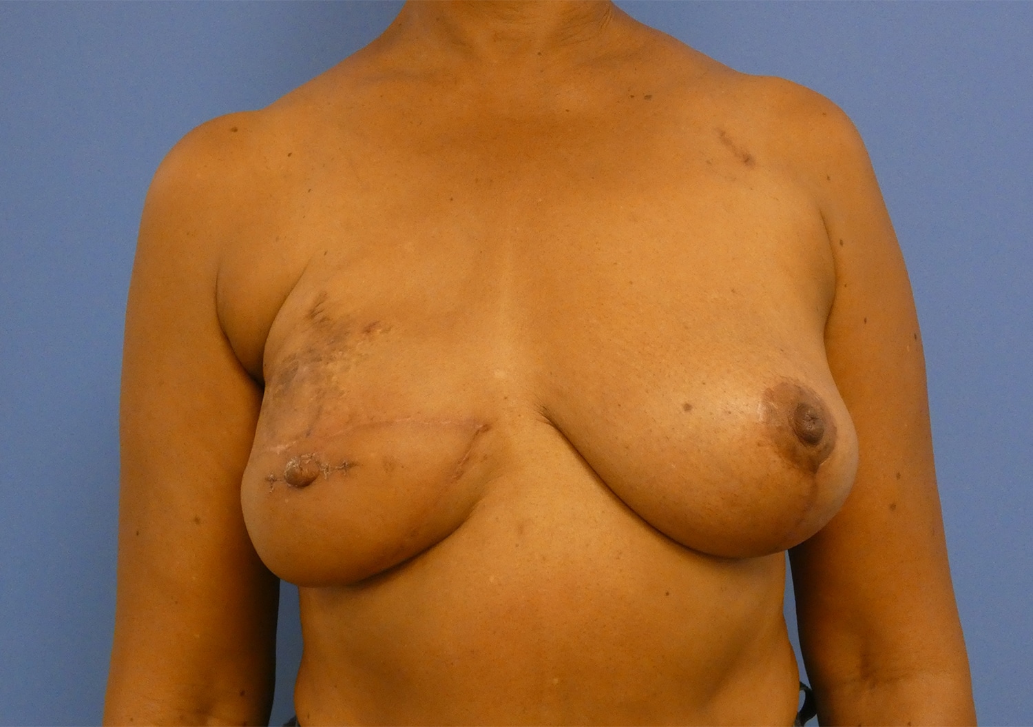 After Image: Breast Reconstruction - front