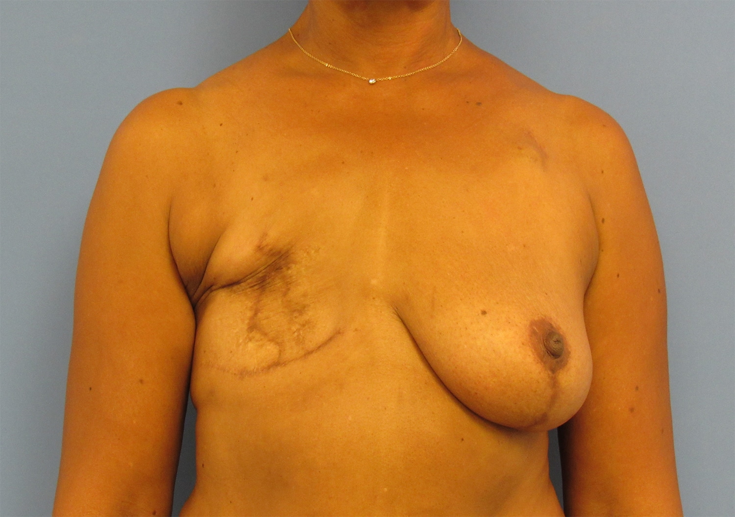 Before Image: Breast Reconstruction - front