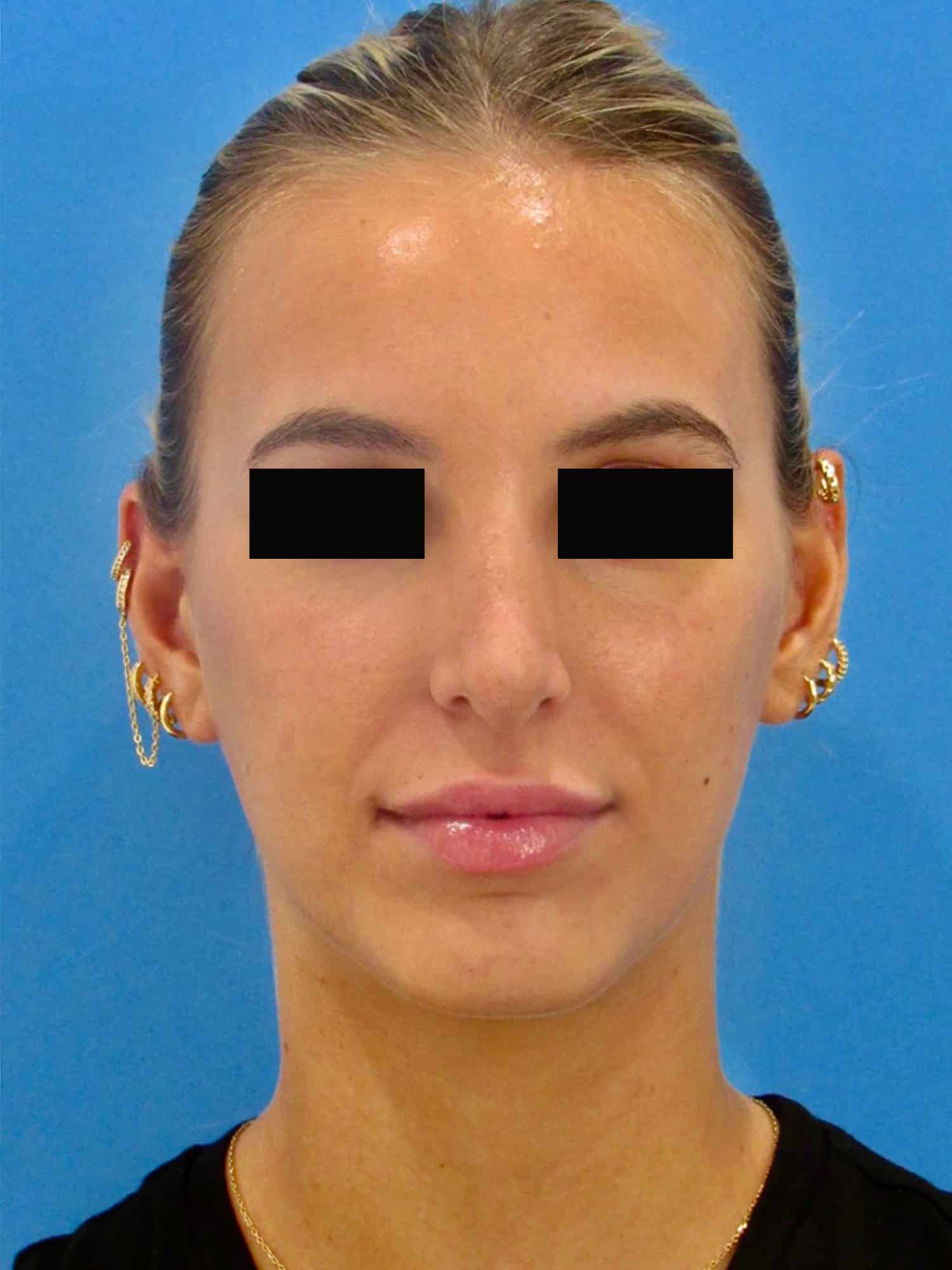 After Image: Rhinoplasty - front