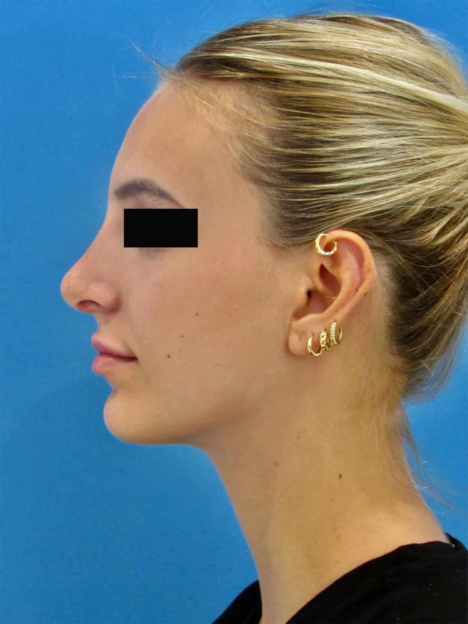 After Image: Rhinoplasty - left-side
