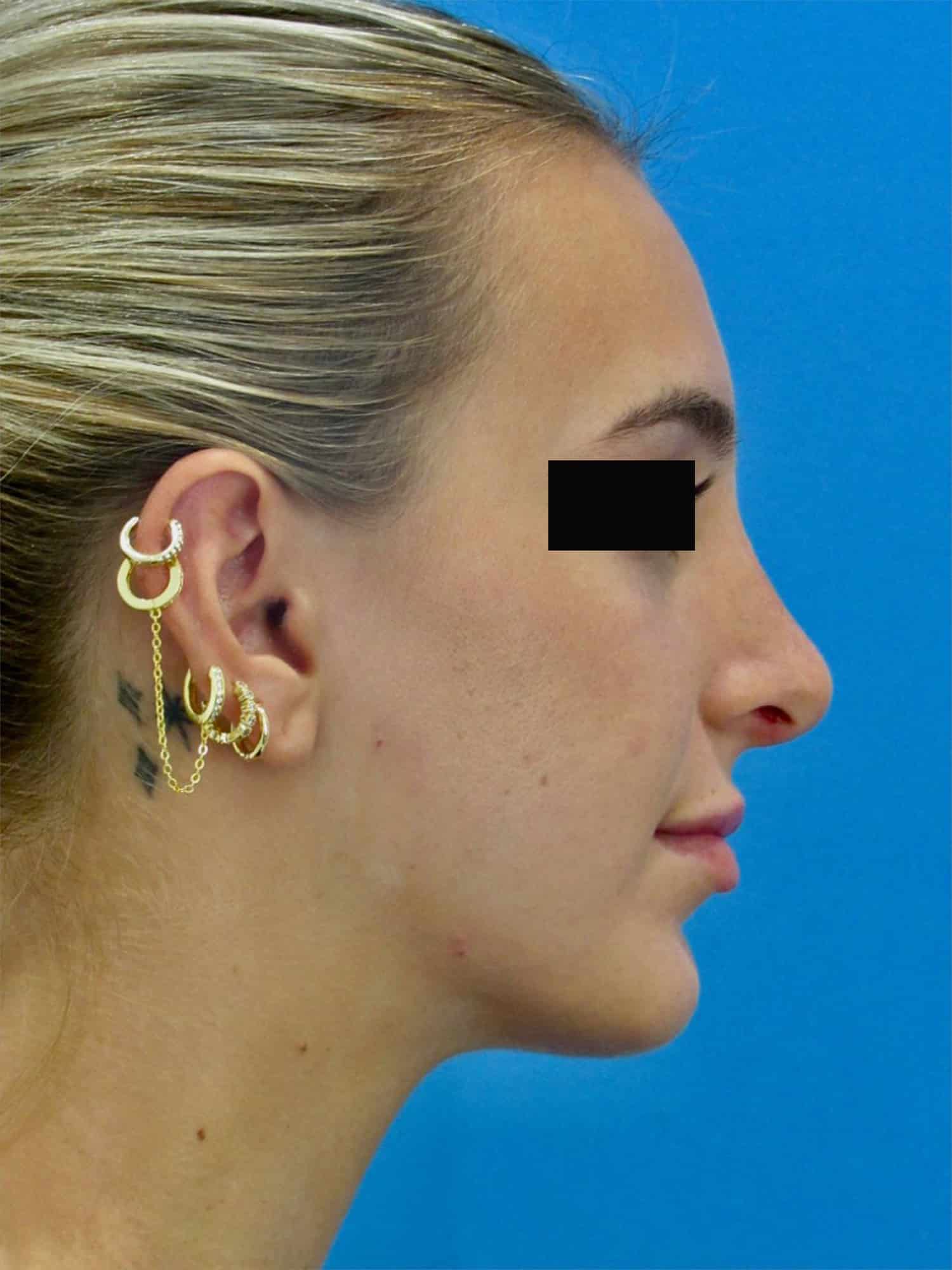 After Image: Rhinoplasty - right-side