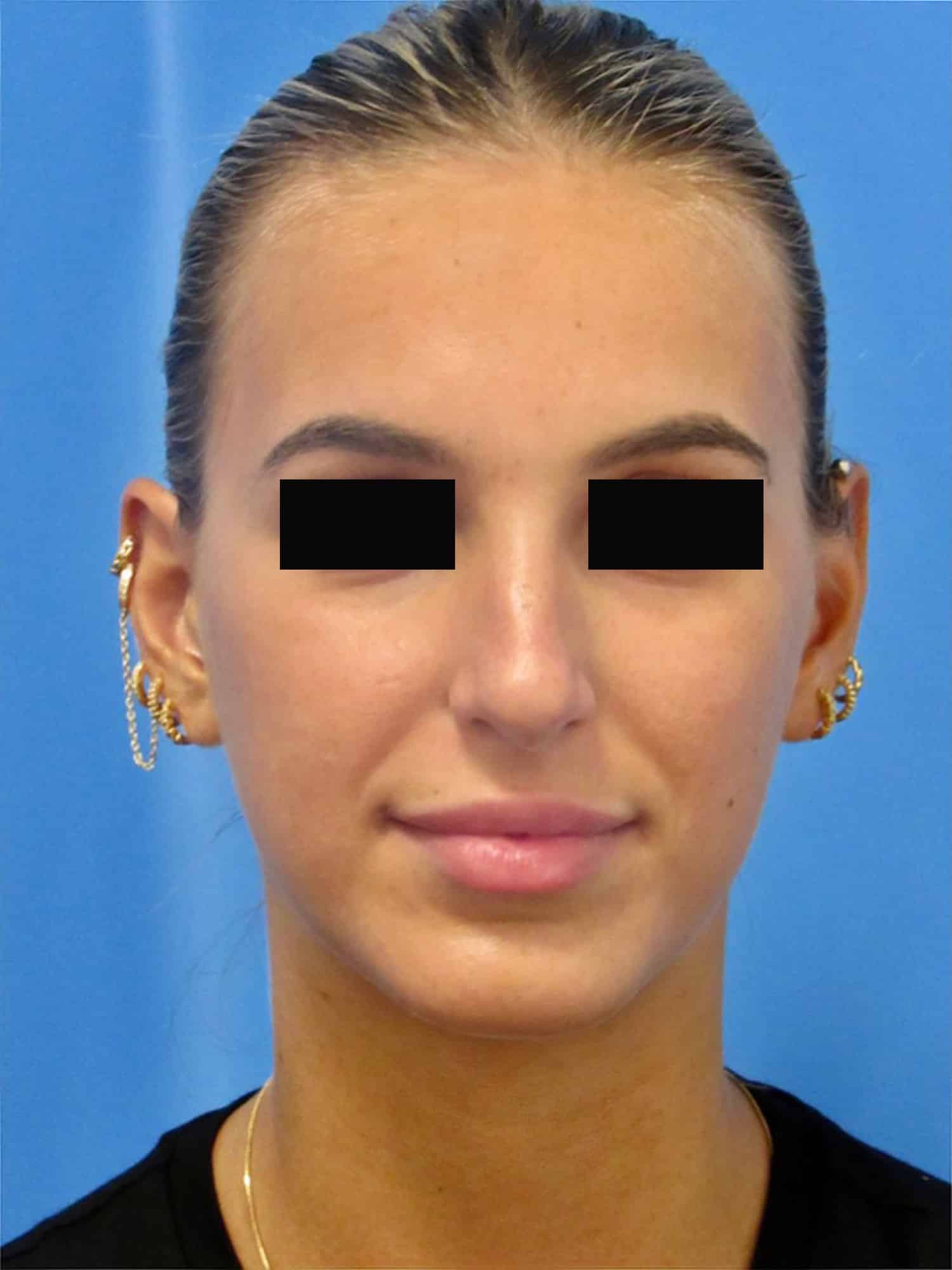 Before Image: Rhinoplasty - front
