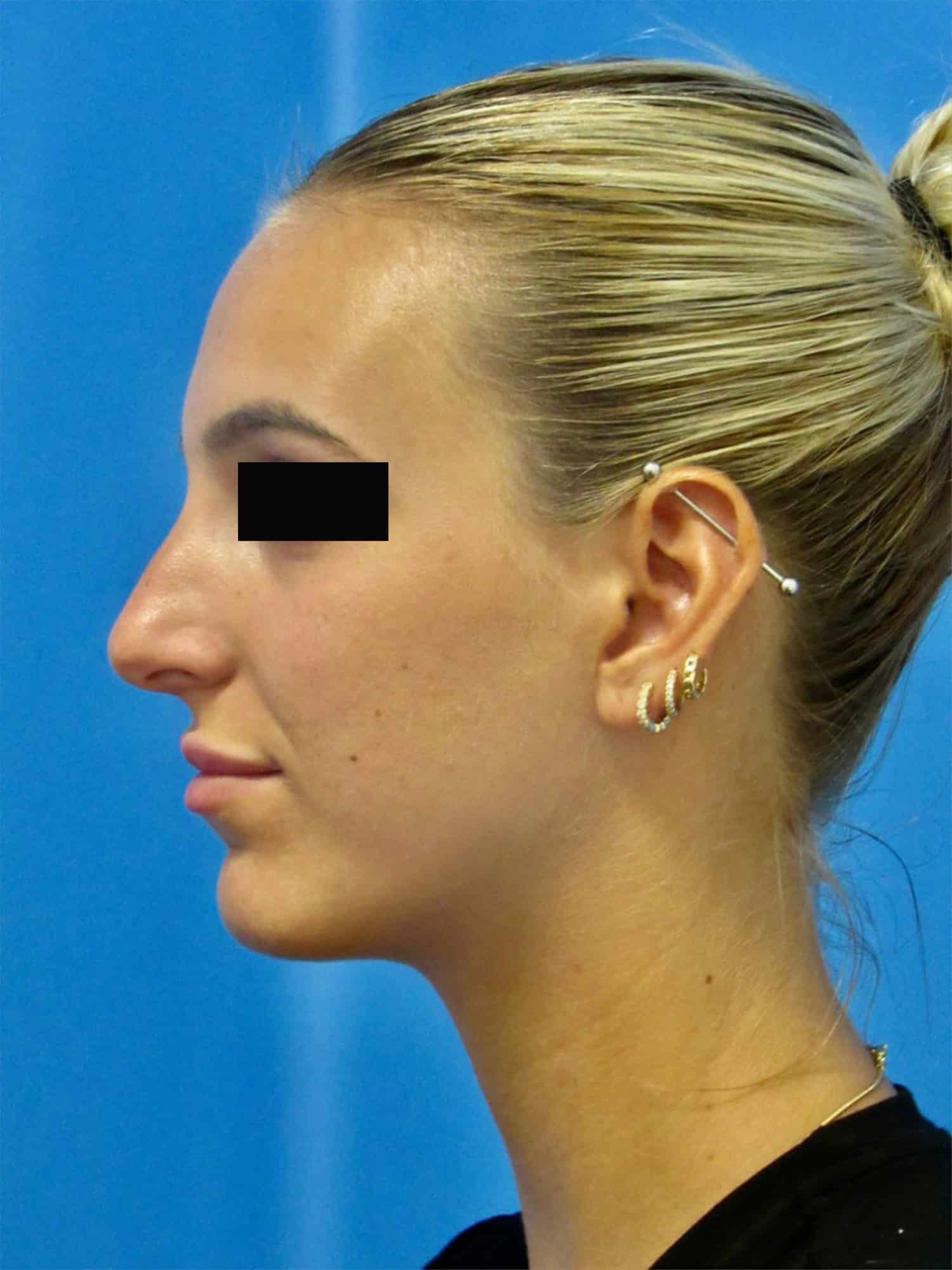 Before Image: Rhinoplasty - left-side