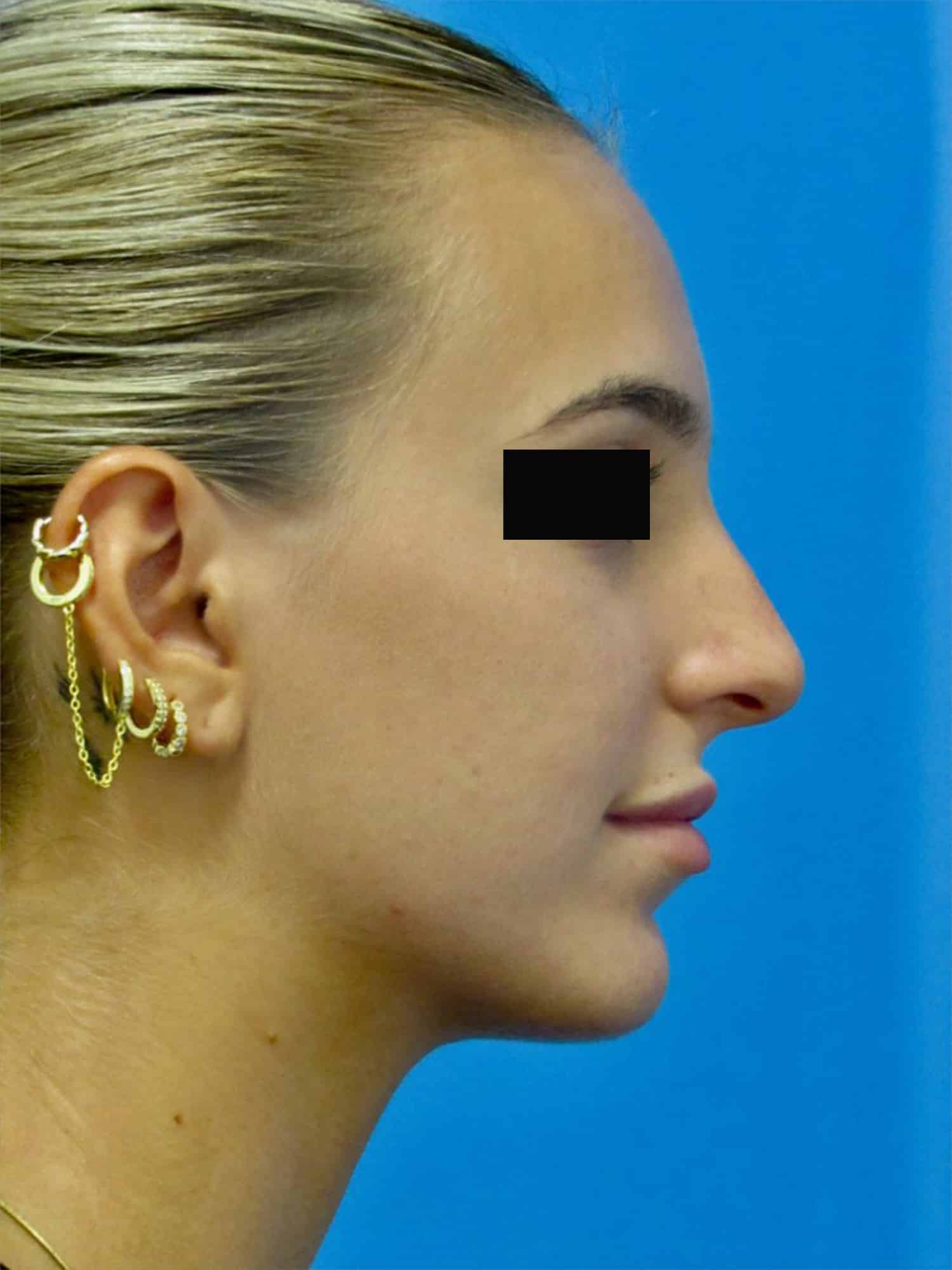 Before Image: Rhinoplasty - right-side