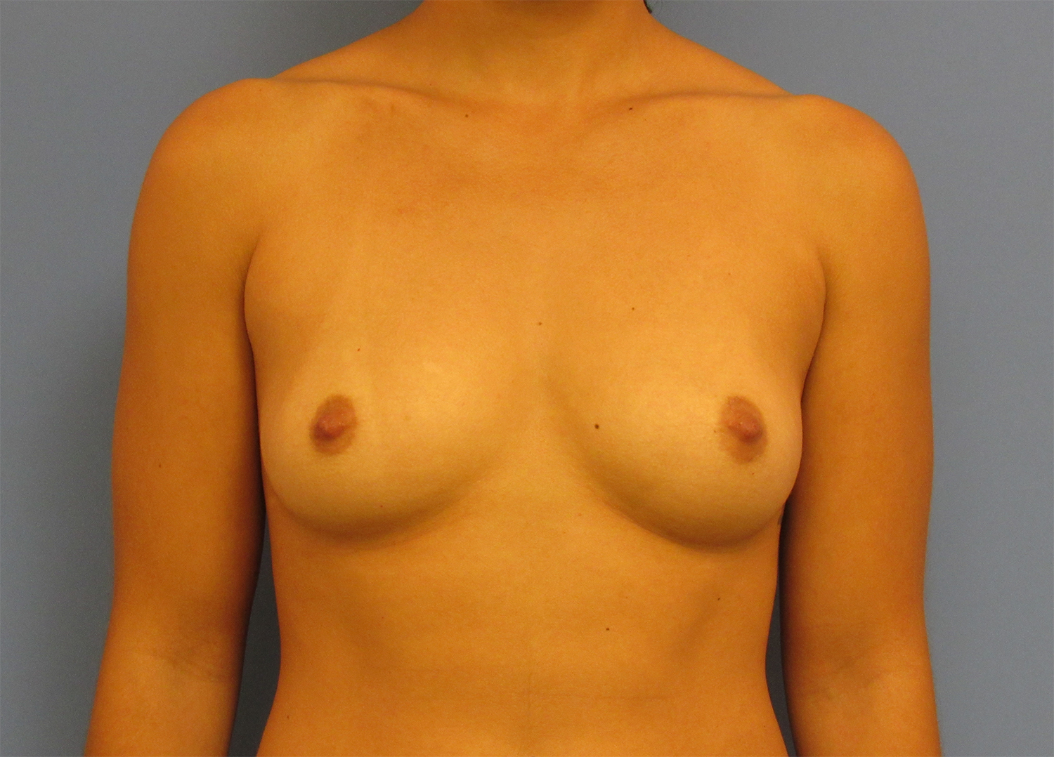Before Image: Breast Augmentation - front