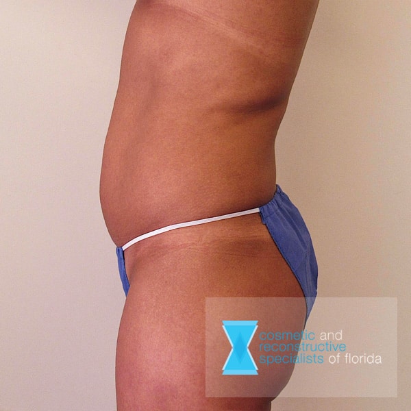 liposuction before procedure fort lauderdale FL