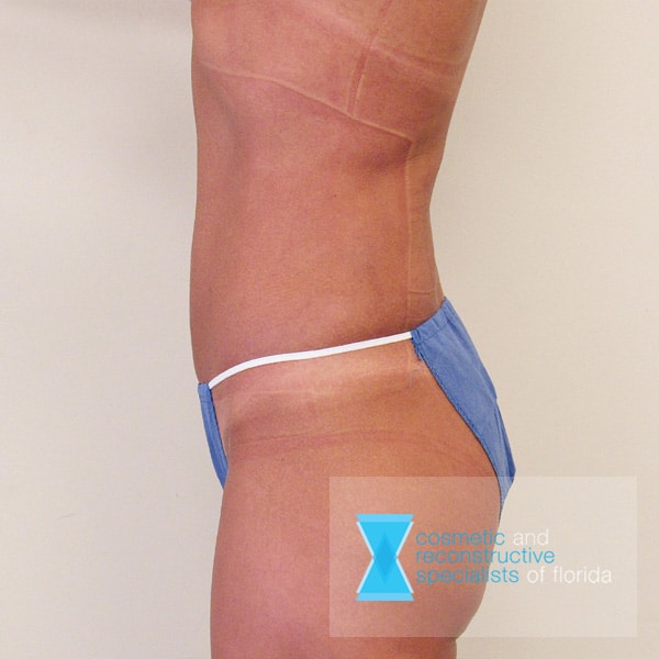 liposuction after procedure fort lauderdale FL