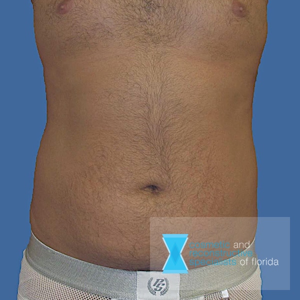 before male liposuction fort lauderdale FL