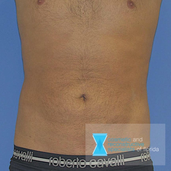 after male liposuction fort lauderdale FL