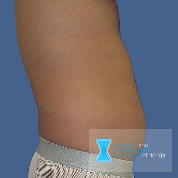 male liposuction before procedure fort lauderdale FL