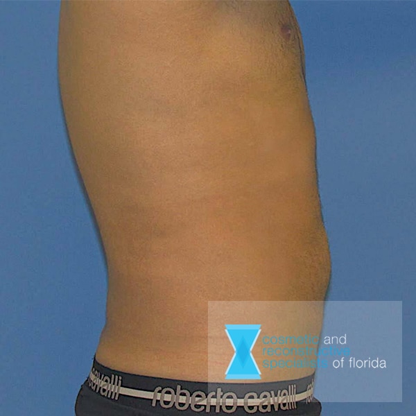 male liposuction after procedure fort lauderdale FL