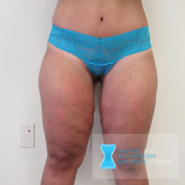 Thigh Lift Fort Lauderdale FL