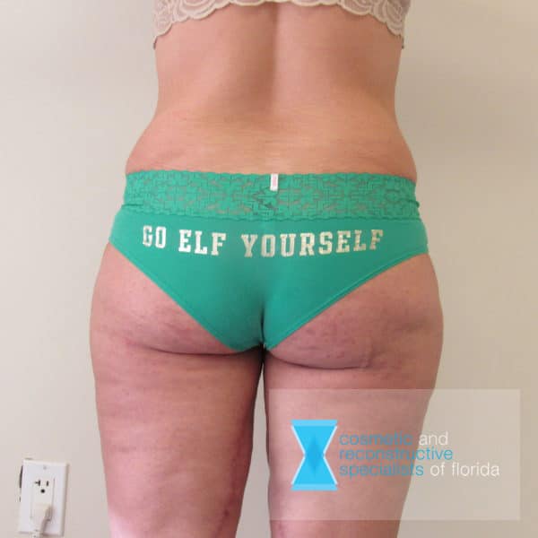 After Thigh Lift Fort Lauderdale FL