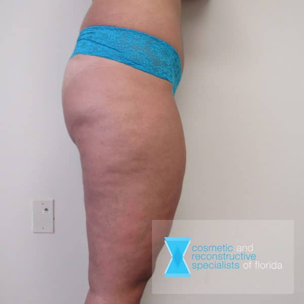 Before Thigh lift surgery Fort Lauderdale FL