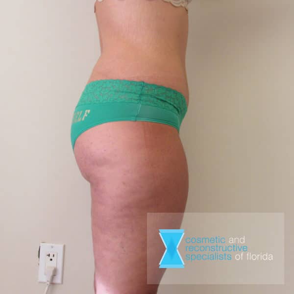 After Thigh Lift Surgery Fort Lauderdale FL