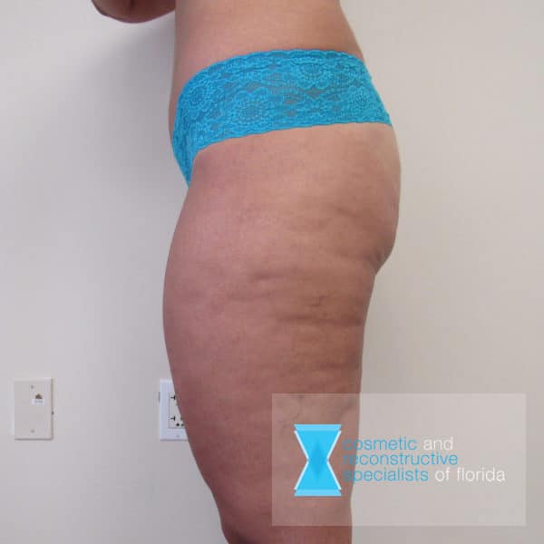 Before Thigh Lift Fort Lauderdale