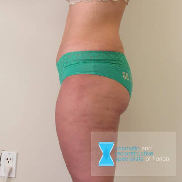 After Thigh Lift Surgery Florida FL