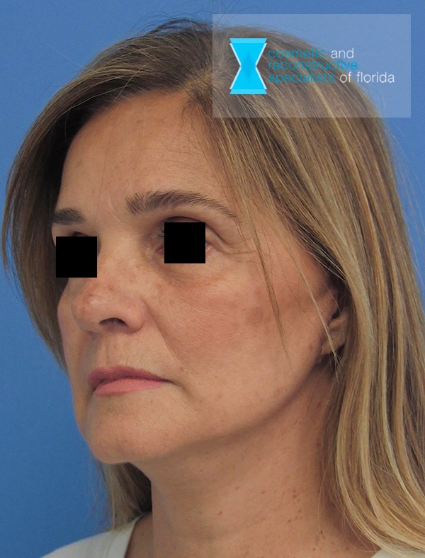 After Face Lift Fort Lauderdale FL