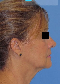 Before Rhytidectomy Surgery Fort Lauderdale FL