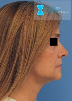 After Rhytidectomy Surgery Fort Lauderdale FL