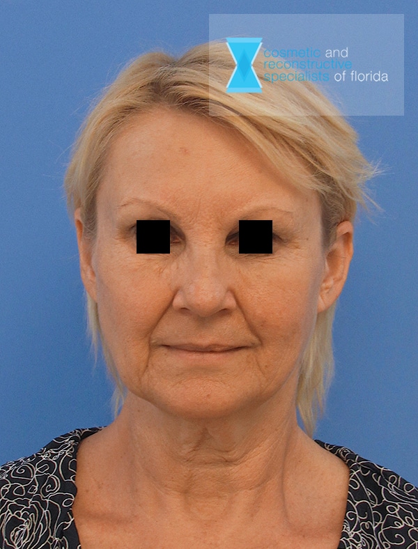 Before Facelift Surgery Fort Lauderdale FL