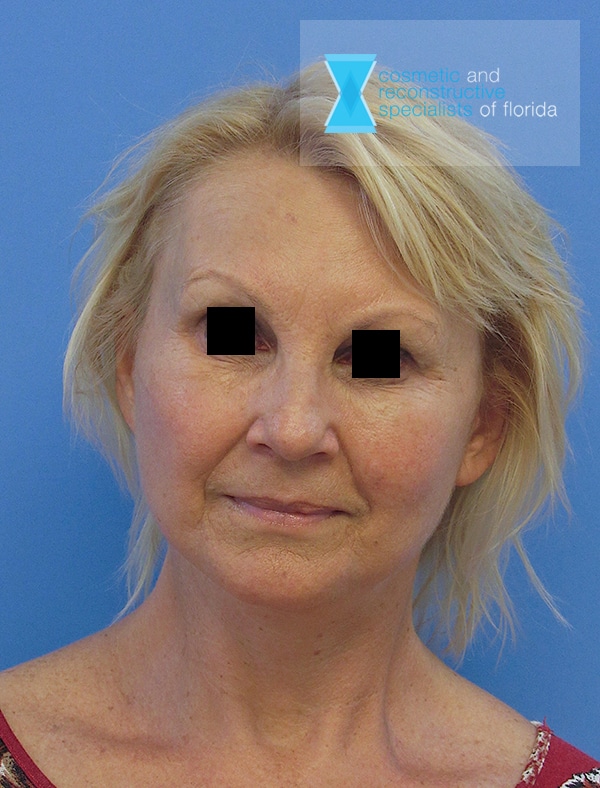 After Facelift Surgery Fort Lauderdale FL