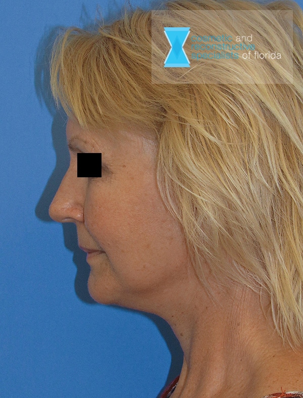 Post OP Face Lift Fort Lauderdale FL