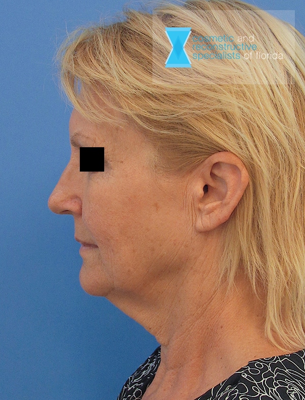 Pre OP Rhytidectomy Treatment Fort Lauderdale